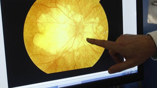 Un especialista en el Hospital Macarena, referente en problemas oculares,  señala una foto de fondo de ojo a una paciente que padece una atrofia en la mácula.