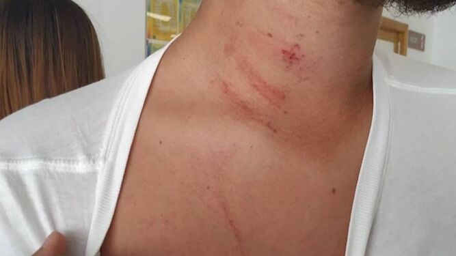 Imagen del cuello del árbitro tomada en el hospital tras la agresión.