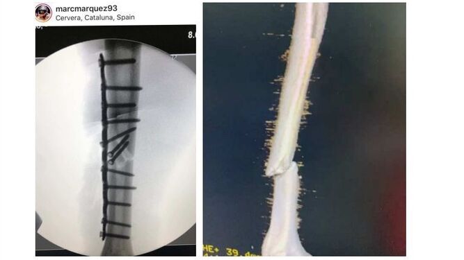 Marc Márquez ha compartido en las redes sociales una radiografía en la que se aprecian los 12 clavos que le sujetan la placa para reducir la fractura, que aparece en la radiografía en 3D de la derecha.