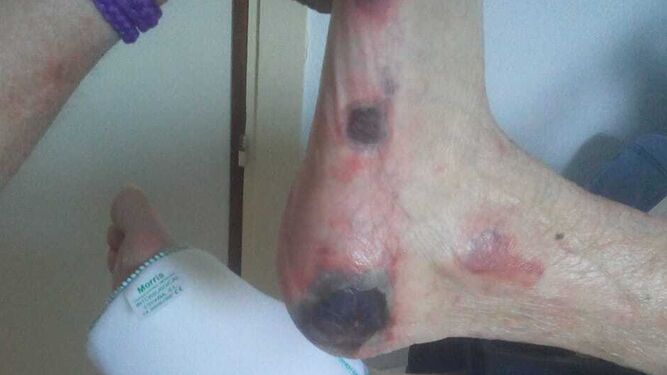 Una imagen en la que se pueden ver las úlceras de la paciente.