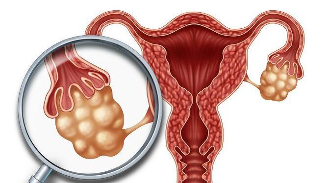 Síndrome del ovario poliquístico: Síntomas y causas