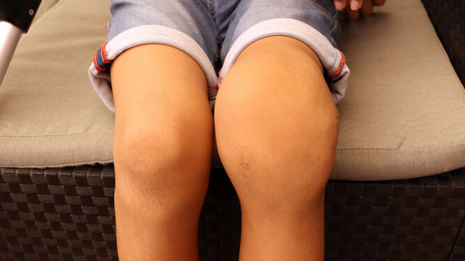 Detalle de la rodilla deformada por el síndrome raro que padece el jerezano Hugo.