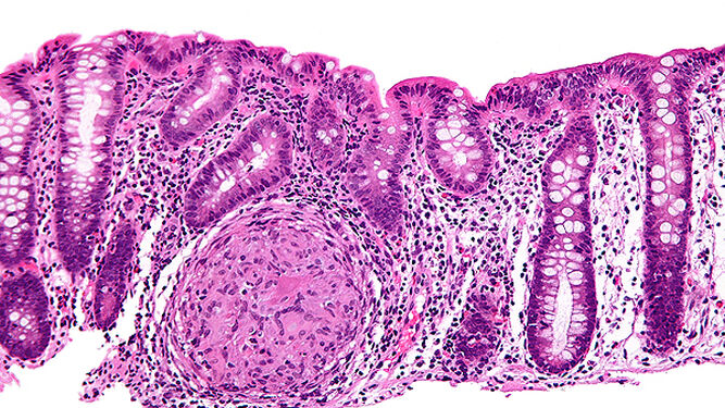 Histopatología de la enfermedad de Crohn